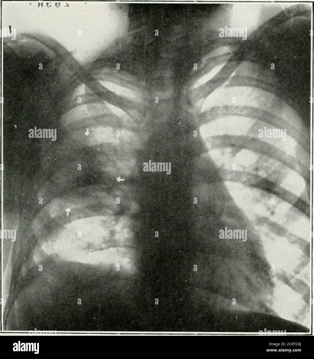 épanchement pleural Banque de photographies et d’images à haute ...