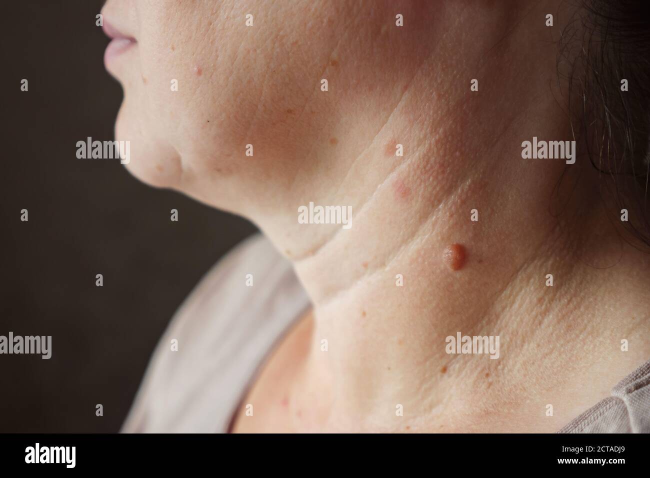 Gros plan d'une mole sur le cou d'une femme. Banque D'Images