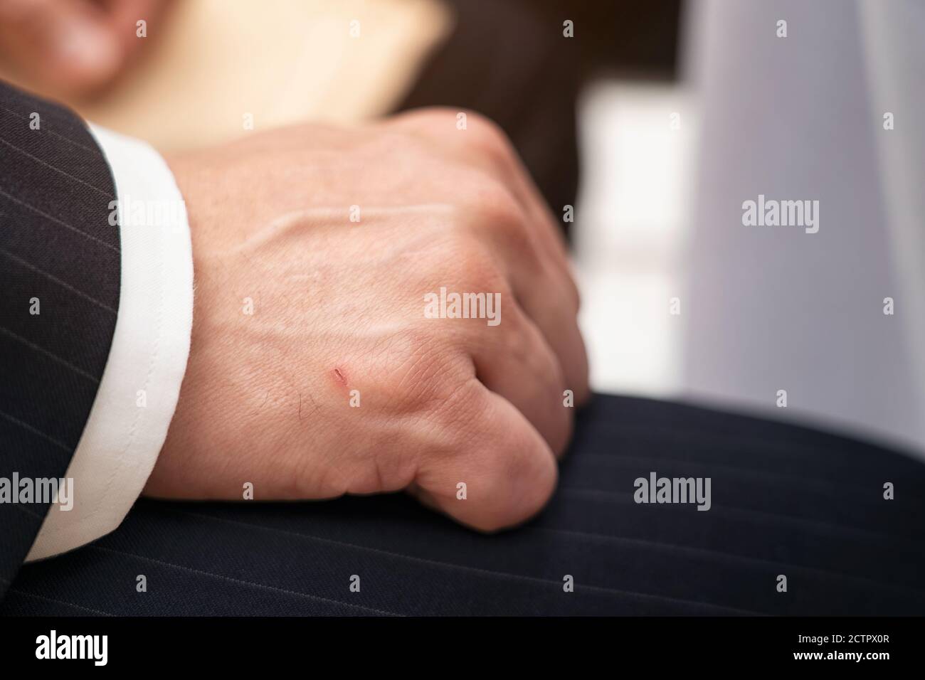 Homme de bussiness montrant une petite lésion sur sa main, accident blessé main mâle, des marques de plaie sur le côté droit, peu de lésion sur la main. Banque D'Images