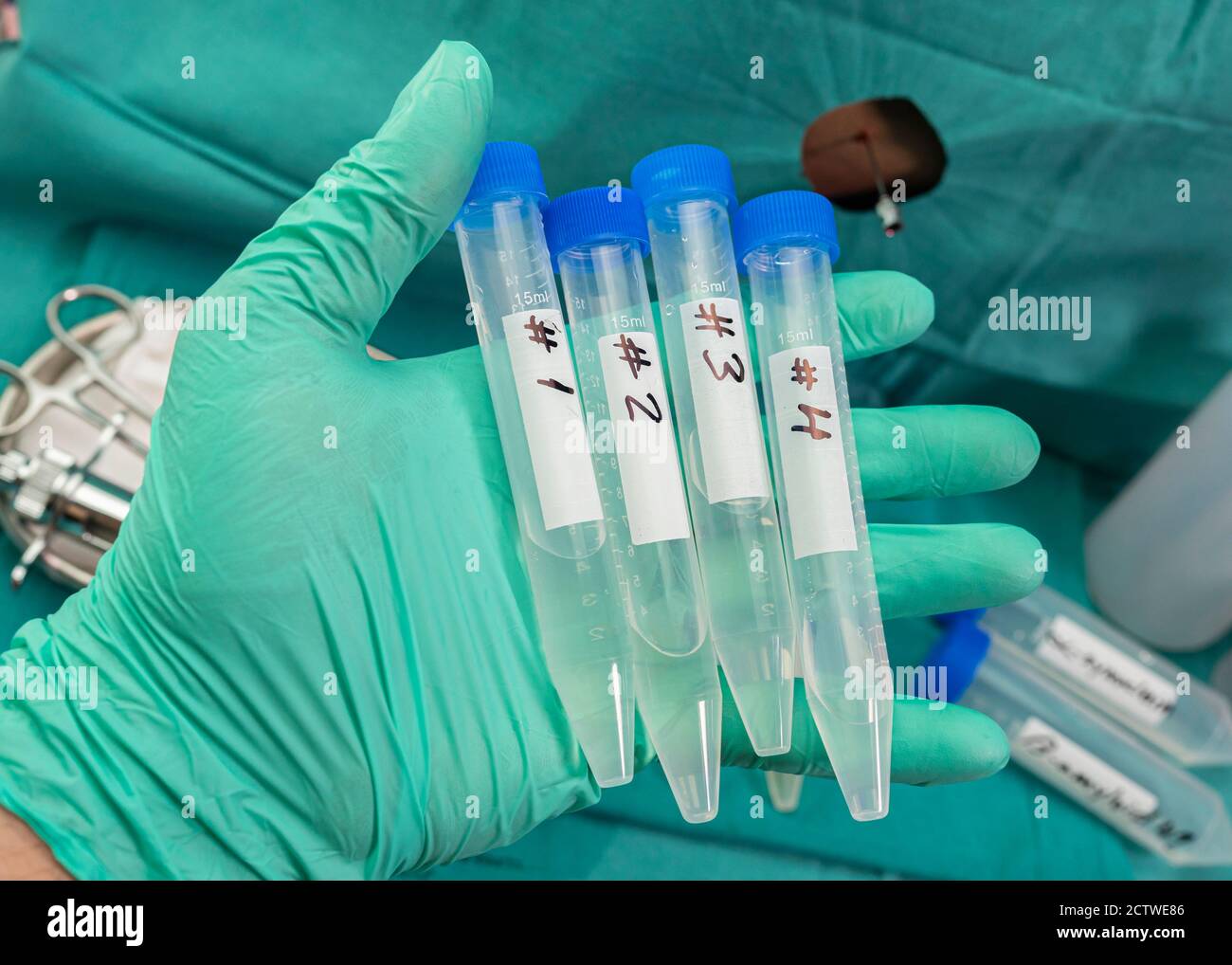 Flacons contenant quatre échantillons de liquide céphalo-rachidien chez des patients atteints de myélite transversale après injection d'un vaccin expérimental Oxford Covid-19, Banque D'Images