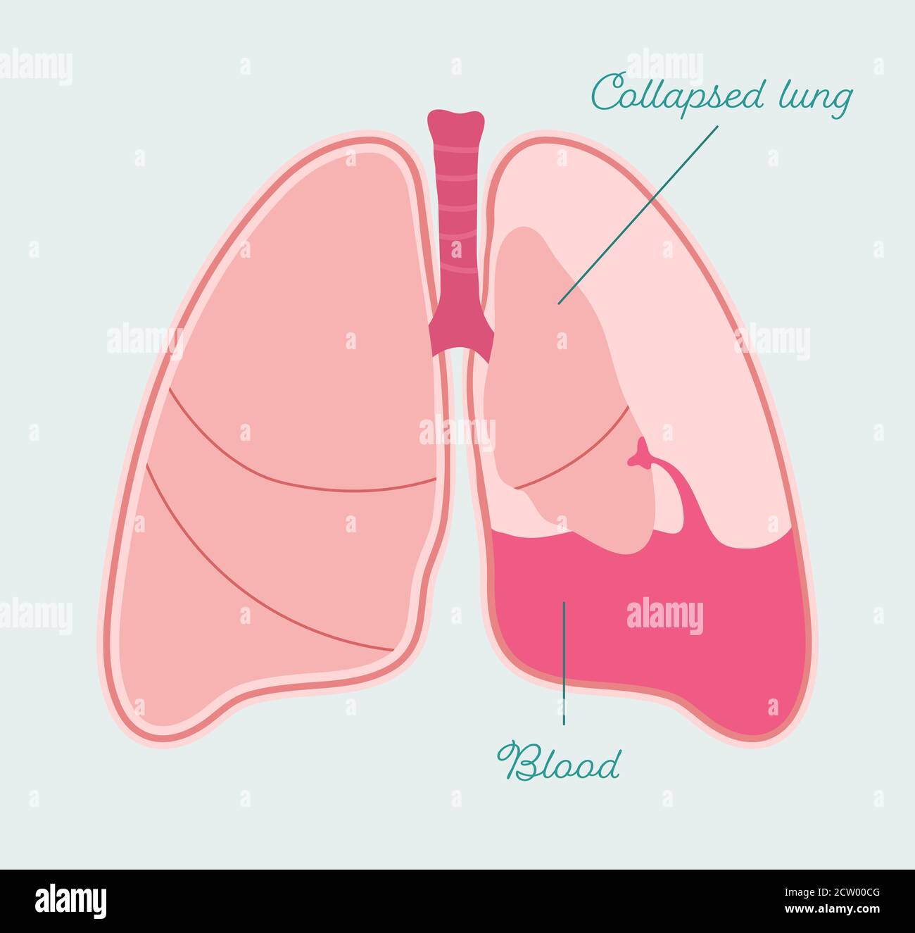 Hémothorax des poumons. Saignement et collapsed poumon humain - schéma anatomique vectoriel Illustration de Vecteur