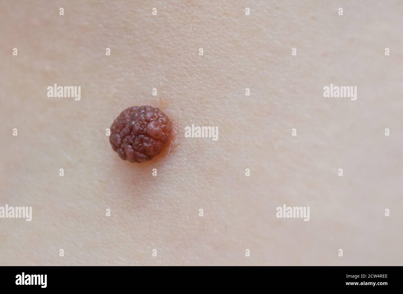 La mole innée en gros plan. Capture macro de lésion cutanée bénigne. Prolifération de cellules pigmentaires éliminer, naevus pigmenté mélanocytaire, naevus naevocytaire. Banque D'Images