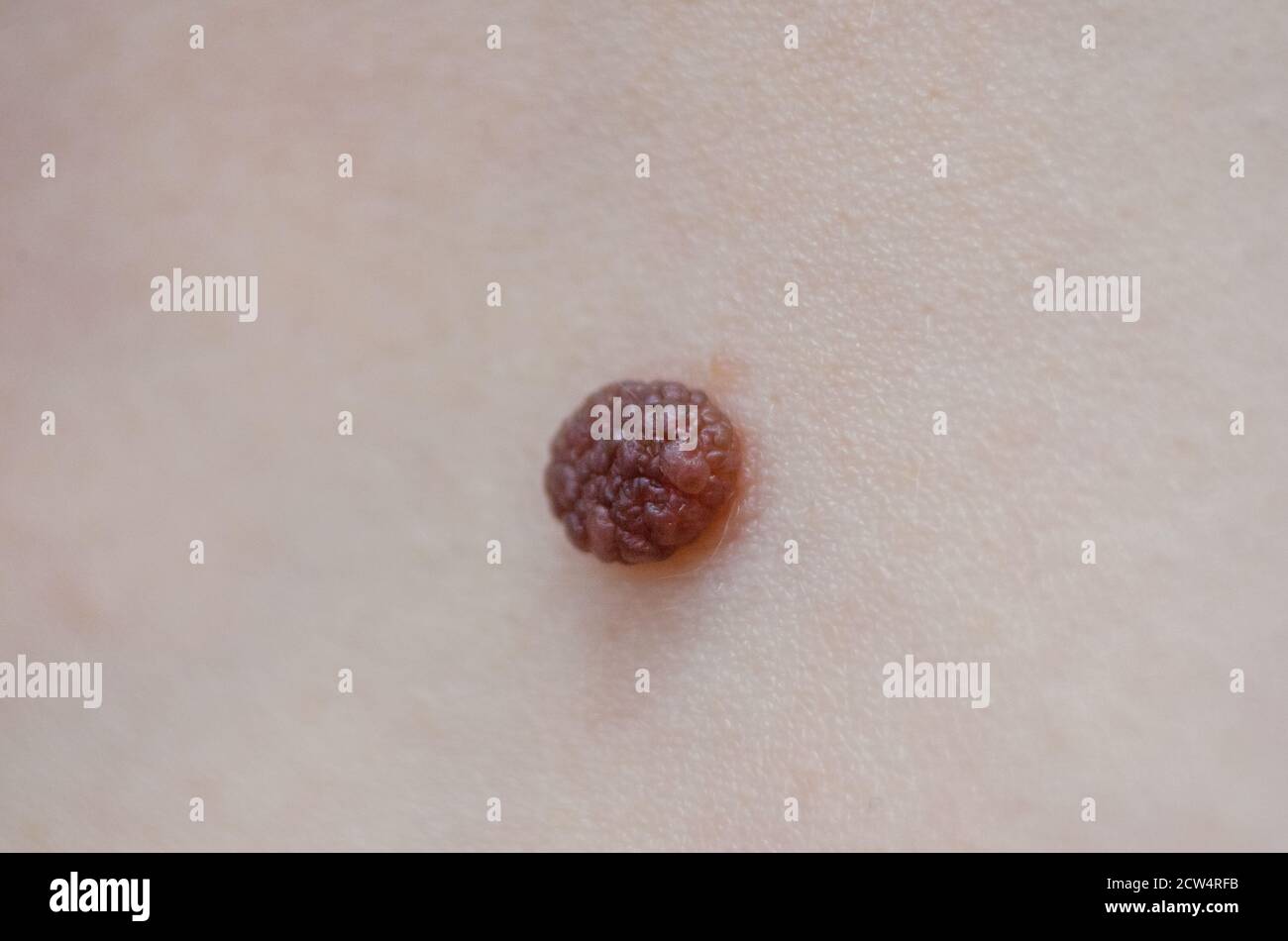 La mole innée en gros plan. Capture macro de lésion cutanée bénigne. Prolifération de cellules pigmentaires éliminer, naevus pigmenté mélanocytaire, naevus naevocytaire. Banque D'Images