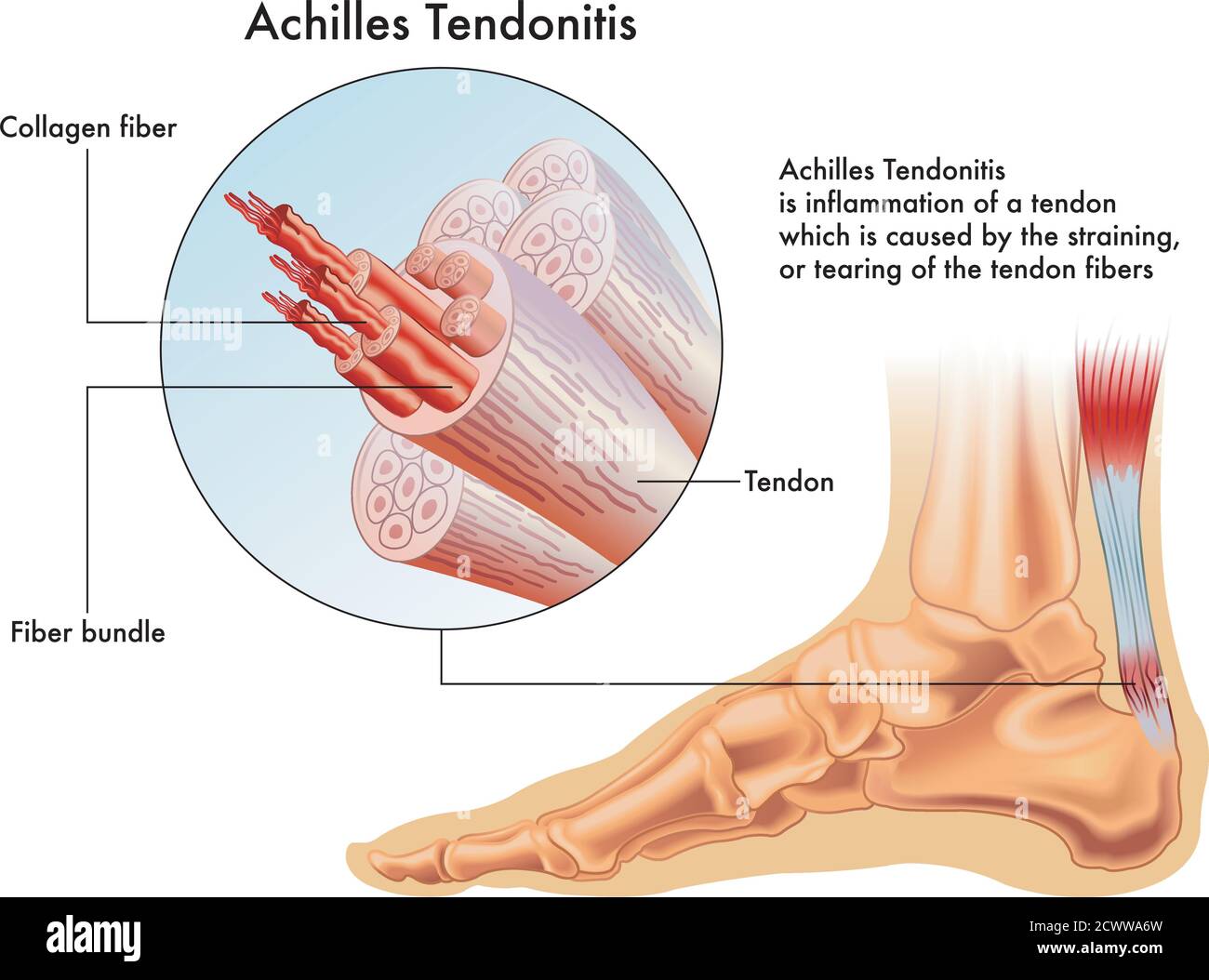 Une illustration médicale des symptômes d'Achilles tendonitis ou l'inflammation d'un tendon d'Achille. Illustration de Vecteur