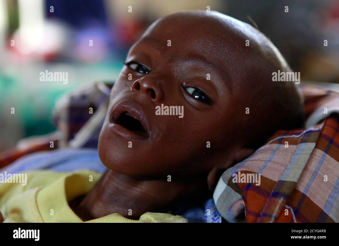 Minhaj Gedi Farahi A Seven Month Old Severely Malnourished Refugee Child From Somalia Rests Inside The Stabilization Ward In The International Rescue Committee Irc Field Clinic At The Hagadera Refugee Camp In Dadaab Near