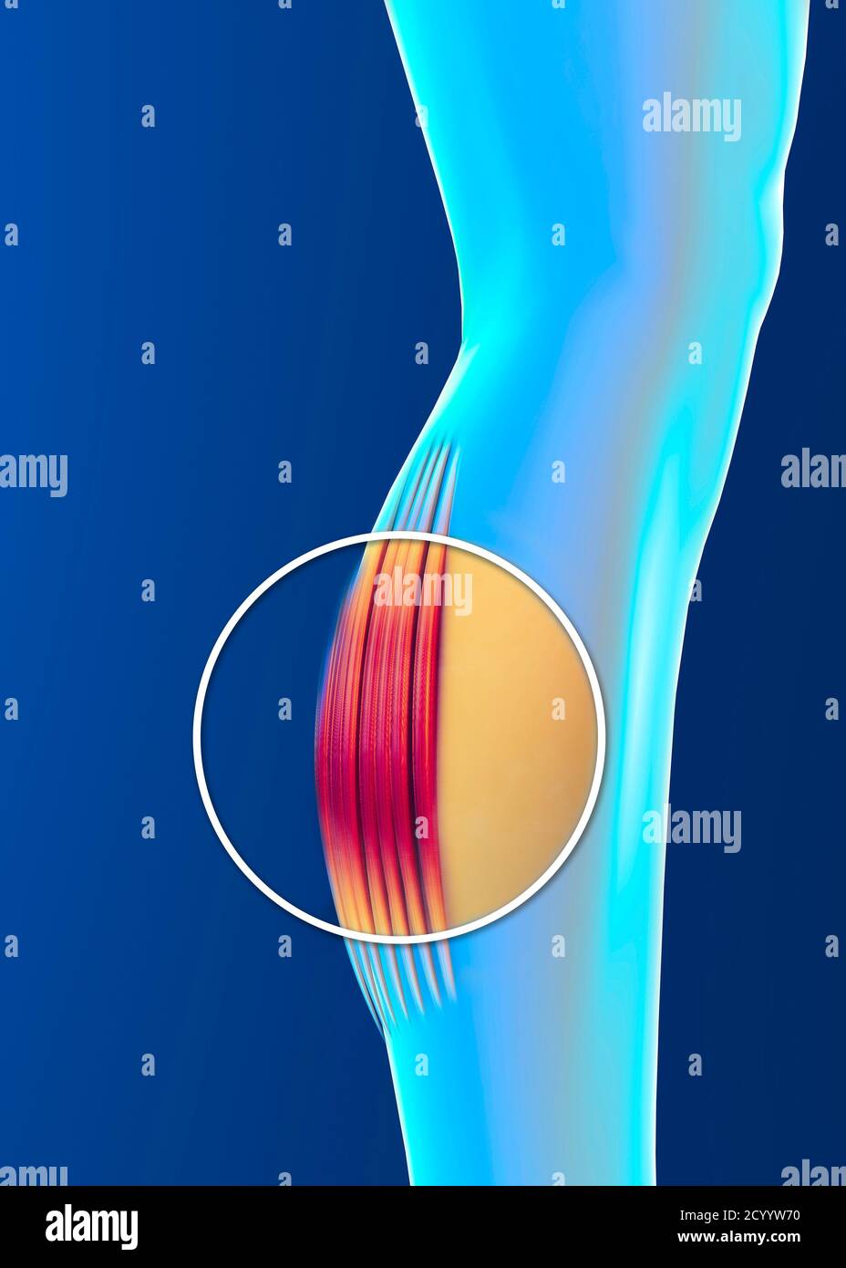 Tension musculaire, inflammation des muscles. Mollet. Crampes. Tendons. Contractures. Corps et anatomie humains, forme physique, exercices physiques Banque D'Images