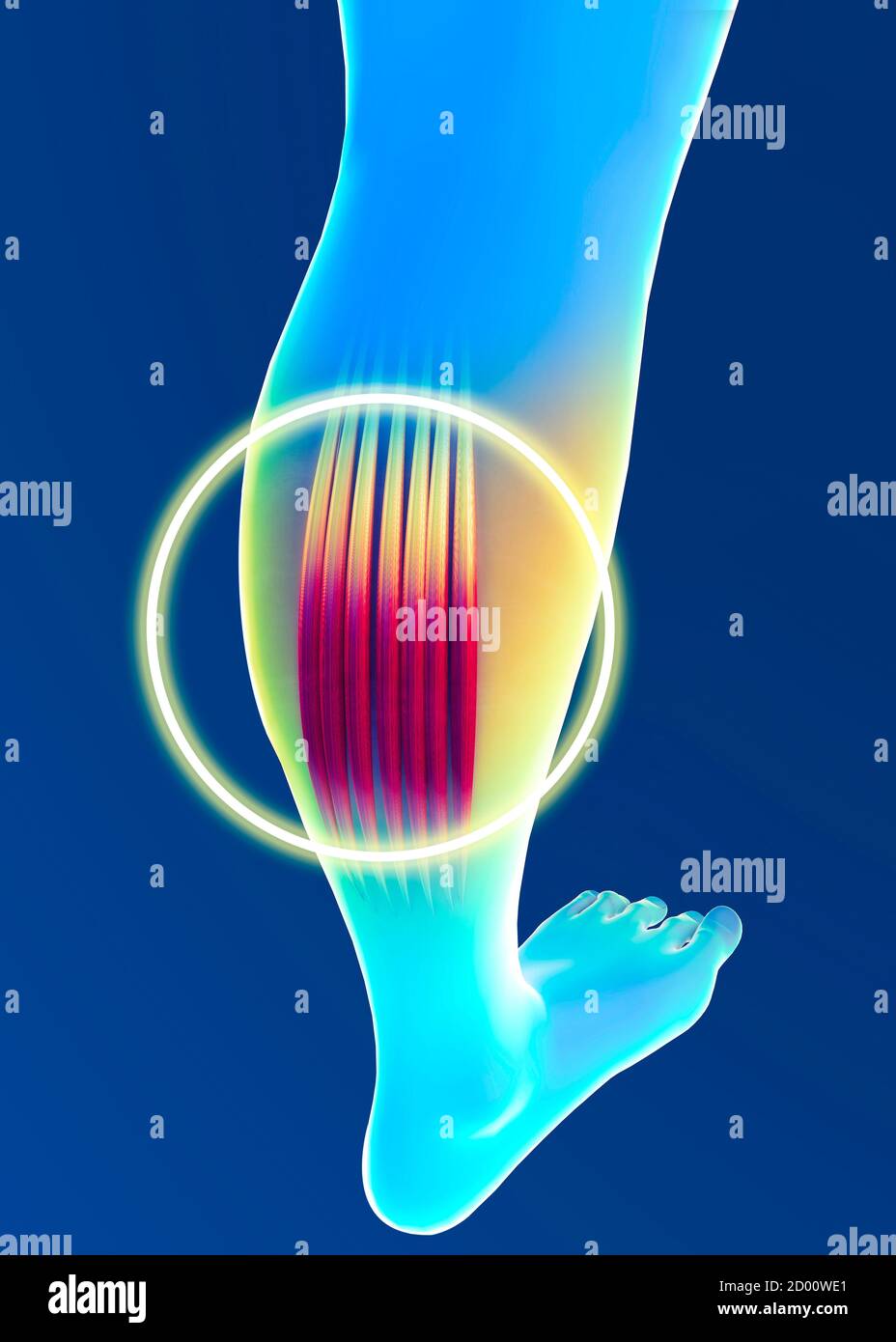 Tension musculaire, inflammation des muscles. Mollet. Crampes. Tendons. Contractures. Corps et anatomie humains, forme physique, exercices physiques Banque D'Images