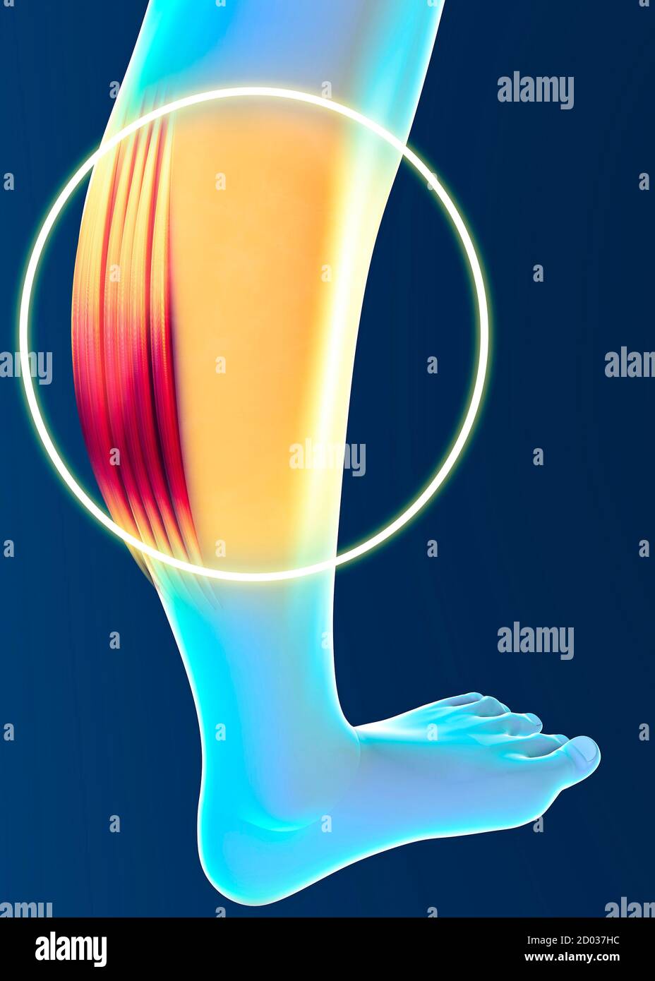 Tension musculaire, inflammation des muscles. Mollet. Crampes. Tendons. Contractures. Corps et anatomie humains, forme physique, exercices physiques Banque D'Images