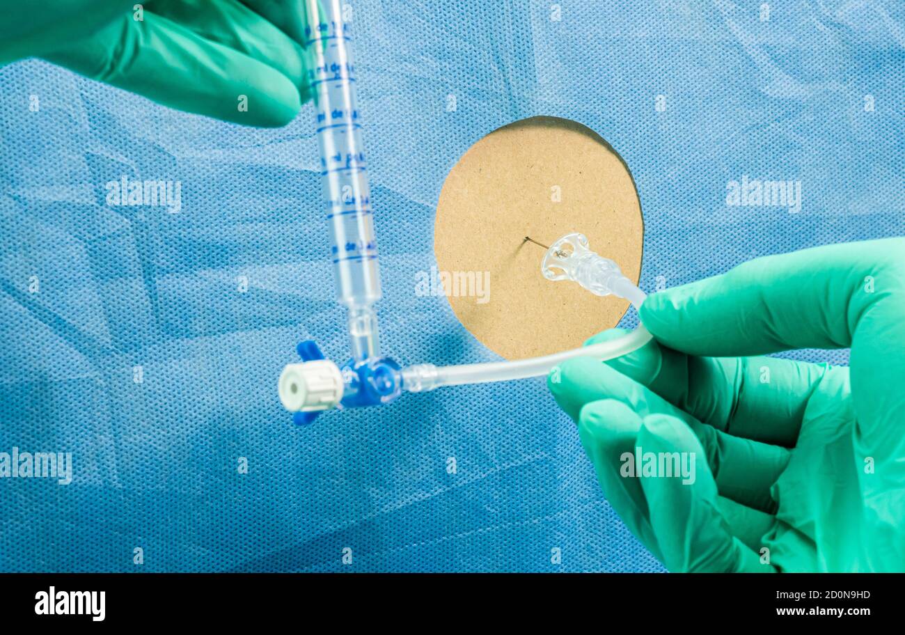 Personne atteinte de myélite transverse après avoir été injectée par le vaccin expérimental Oxford Covid-19, le médecin extrait le liquide céphalo-rachidien pour envahir Banque D'Images