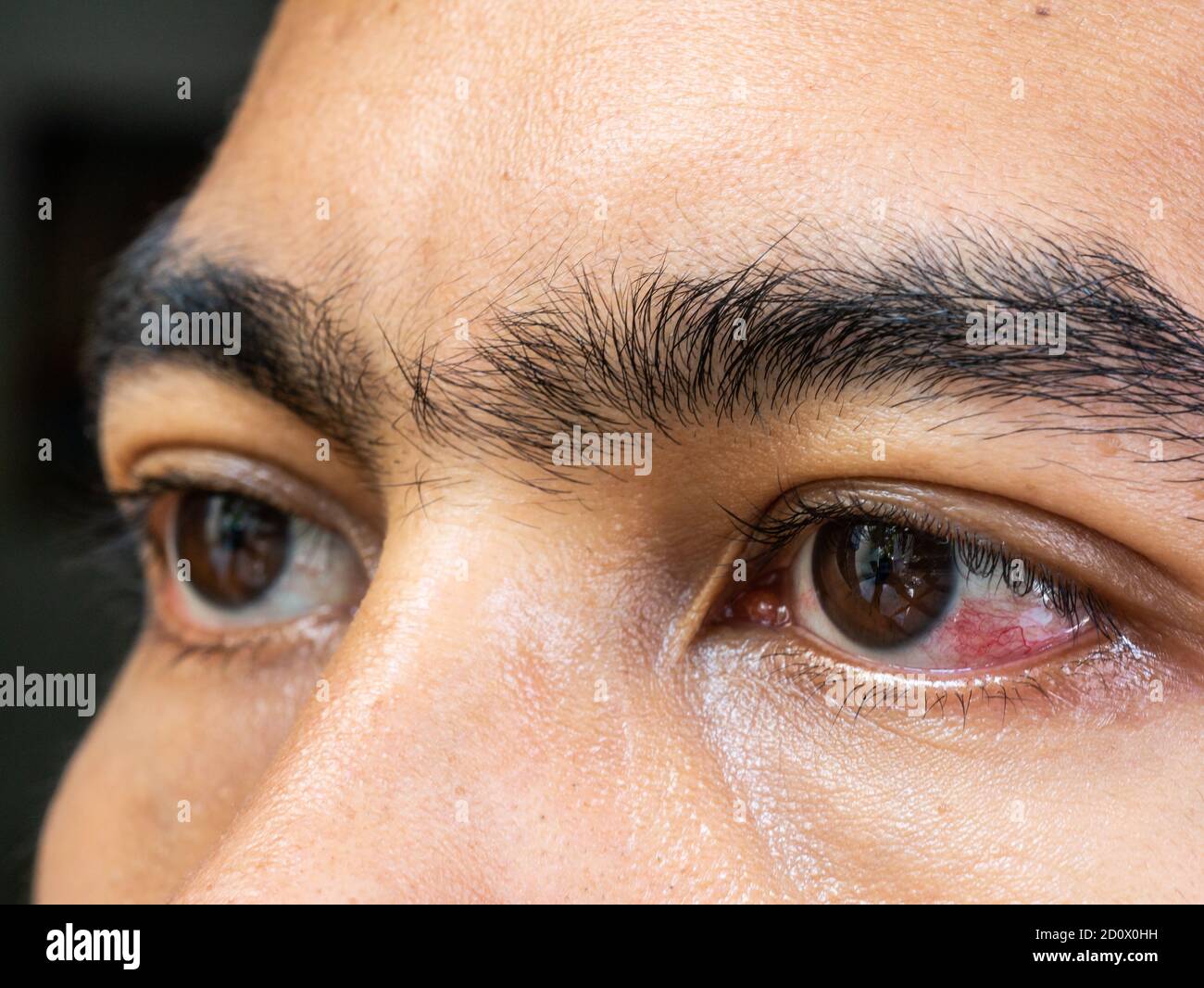 Gros plan yeux rouges irrités du sang de l'homme affectés par la  conjonctivite ou après la grippe, le rhume ou l'allergie Photo Stock - Alamy