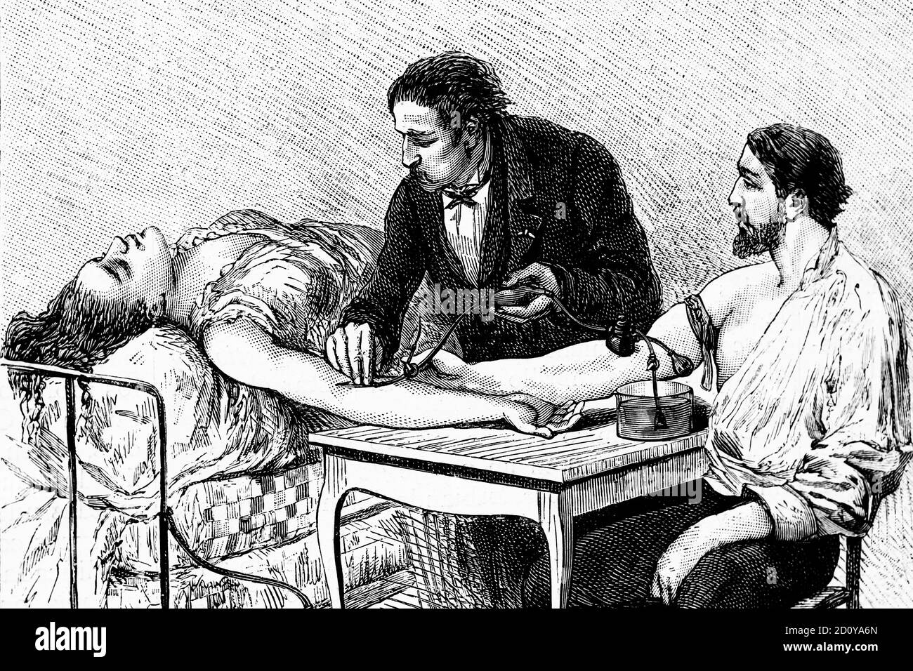 Transfusion sanguine directe. Illustration ancienne. 1882. Banque D'Images