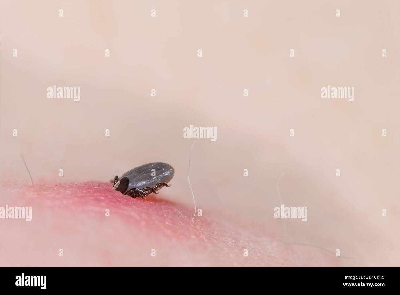 La femelle tick nymph morten dans la peau rose irritée. Ixodes ricinus. Acarien parasite engrabé suçant le sang sur les détails du corps humain. Porteur d'encéphalite. Banque D'Images