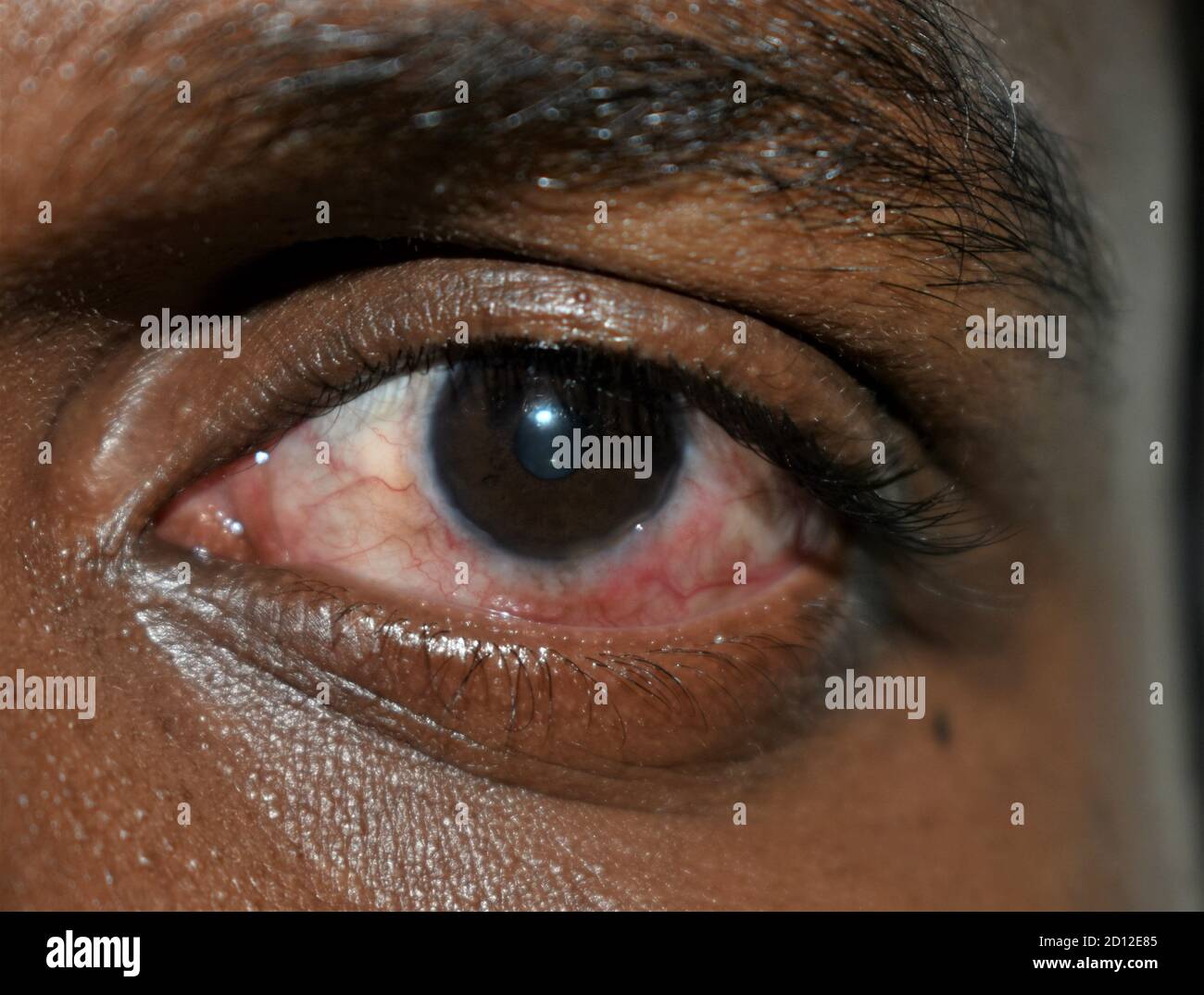 Yeux rouges. Un Indien. Gros plan des yeux rouges agacés d'un homme touché par la conjonctivite ou après la grippe, le rhume ou l'allergie. Maladie et traitement. Banque D'Images