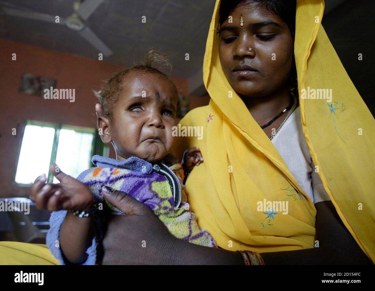 Malnourished Children Swollen Belly Banque De Photographies Et D Images A Haute Resolution Alamy