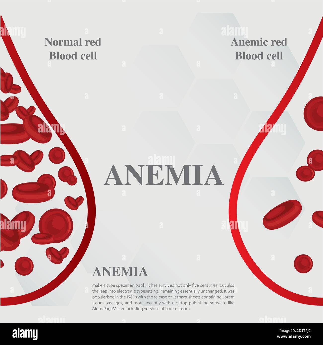 Anémie quantité de sang rouge carence en fer anémie différence d'anémie quantité de globules rouges et symptômes normaux illustration du vecteur médical. Illustration de Vecteur