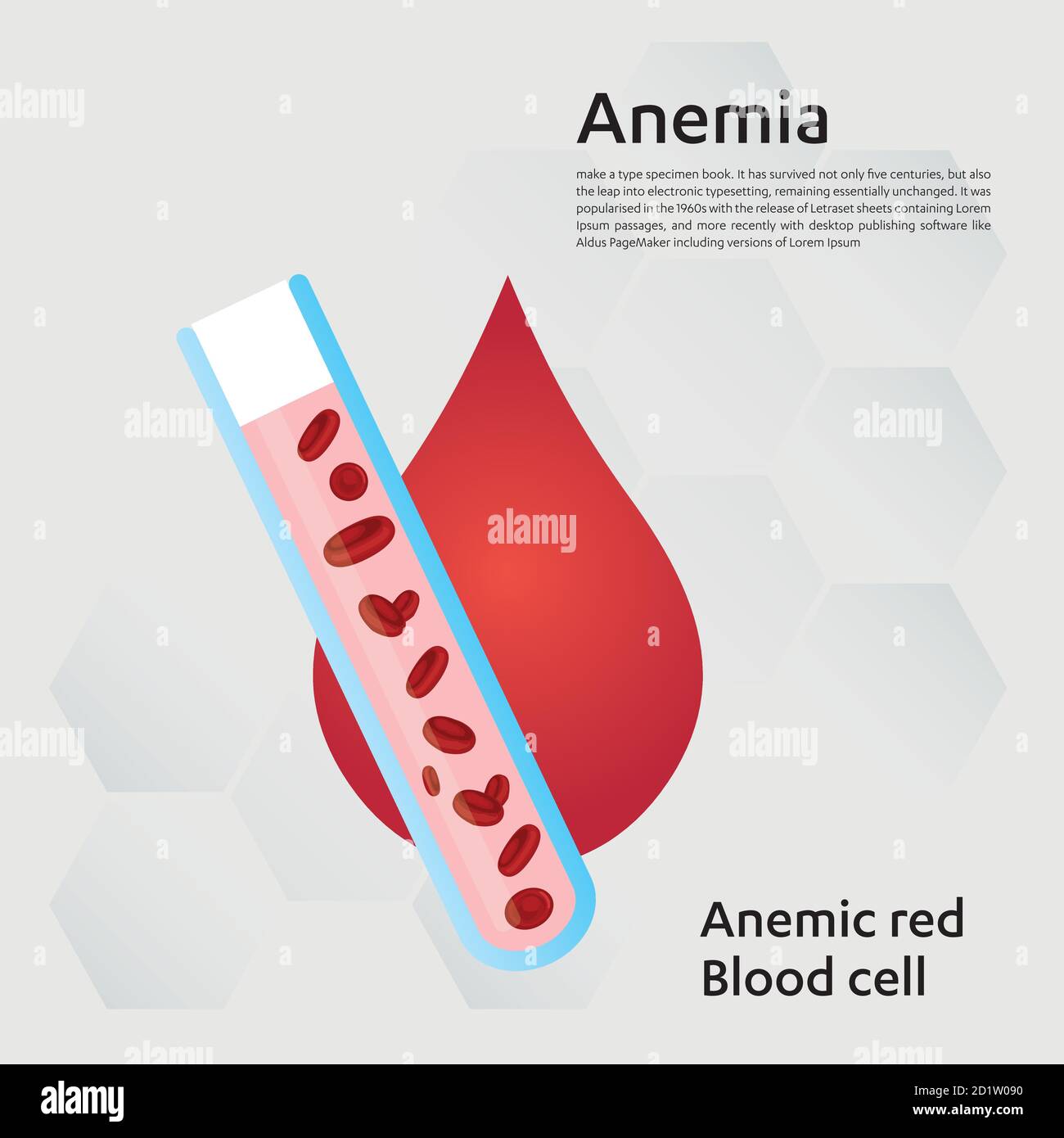 Anémie quantité de sang rouge carence en fer anémie différence d'anémie quantité de globules rouges et symptômes normaux illustration du vecteur médical. Illustration de Vecteur