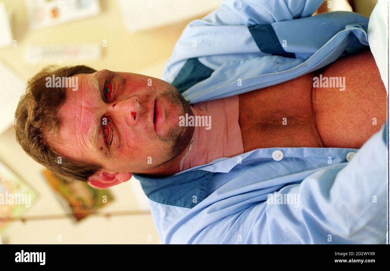 Barry Hayes, un constructeur de 50 ans, à l'hôpital Walton, à Liverpool, après avoir été attaqué par Richard Mellor, 32 ans, dans un parking de pub.Hayes avait raconté au fils de Mellor, âgé de sept ans, qu'il avait attrapé un groupe d'enfants qui avaient gratté sa BMW à Garston, à Liverpool, en 1994.* 26/01/1996 Mellor a été reconnu coupable de lésions corporelles graves à la Cour de la Couronne de Liverpool. Banque D'Images