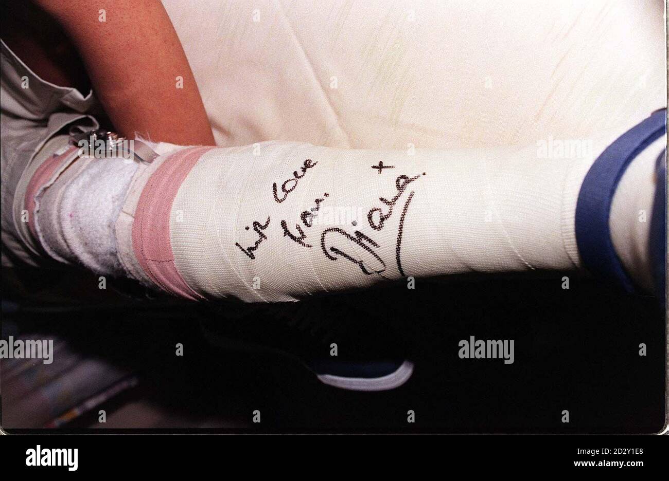 « avec amour de Diana », signé par Diana, princesse de Galles, sur le plâtre de jambe d'Irfan Syed, 15 ans, de Kenton, près de Harrow, Qui est traitée pour une tumeur osseuse, lors de sa visite à l'hôpital Northwick Park, près de Harrow, dans le nord-ouest de Londres, où elle a dévoilé une pierre de fondation pour un nouveau centre de victimes pour enfants. Photo de John Stillwell. Voir PA Story ROYAL Diana. PISCINE. Banque D'Images