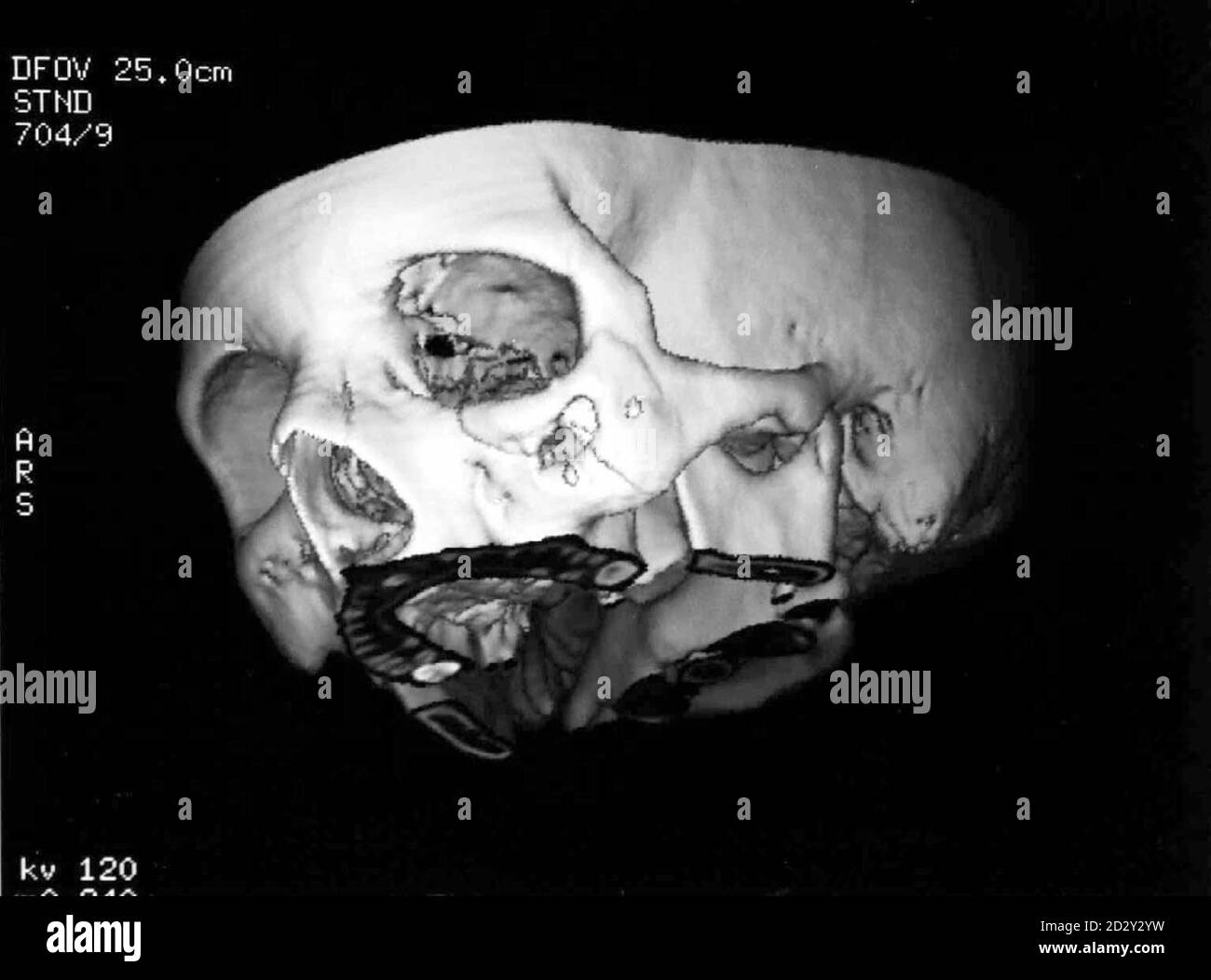 Une radiographie prise à l'hôpital Addenbrookes de Cambridge montrant où une balle de petit calibre a laissé Charlotte Gibbs face. Mme Gibb, a été abattrée à la tête et aux bras pendant ses vacances en Israël avec son petit ami, Max Hunter, qui est mort pendant l'assaut. **les éditeurs, veuillez noter. La plaie de sortie est située sous l'œil gauche.**. Photo de Findley Kember/PA. Voir PA Story CRIME Israël Banque D'Images