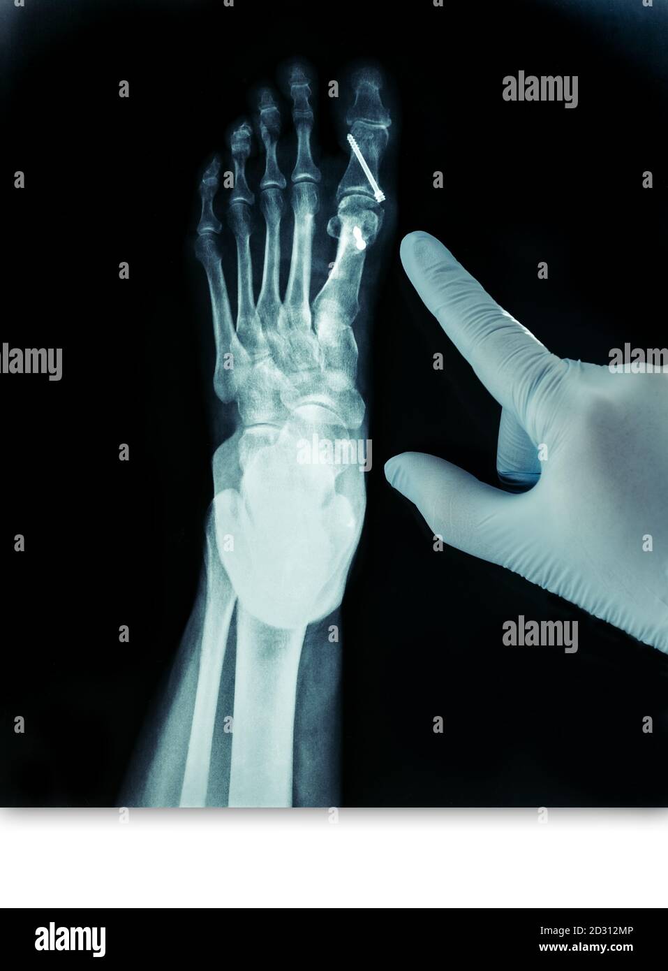 Rayon X du pied avant après la chirurgie de Hallux valgus bleu gants pointés Photo Stock Alamy