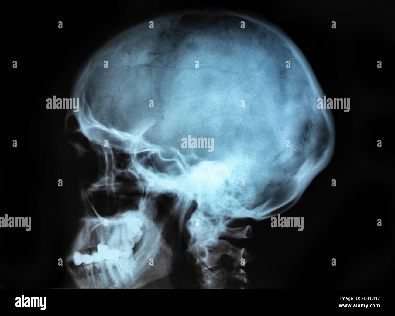 Crâne humain X-ray image isolated on black Banque D'Images