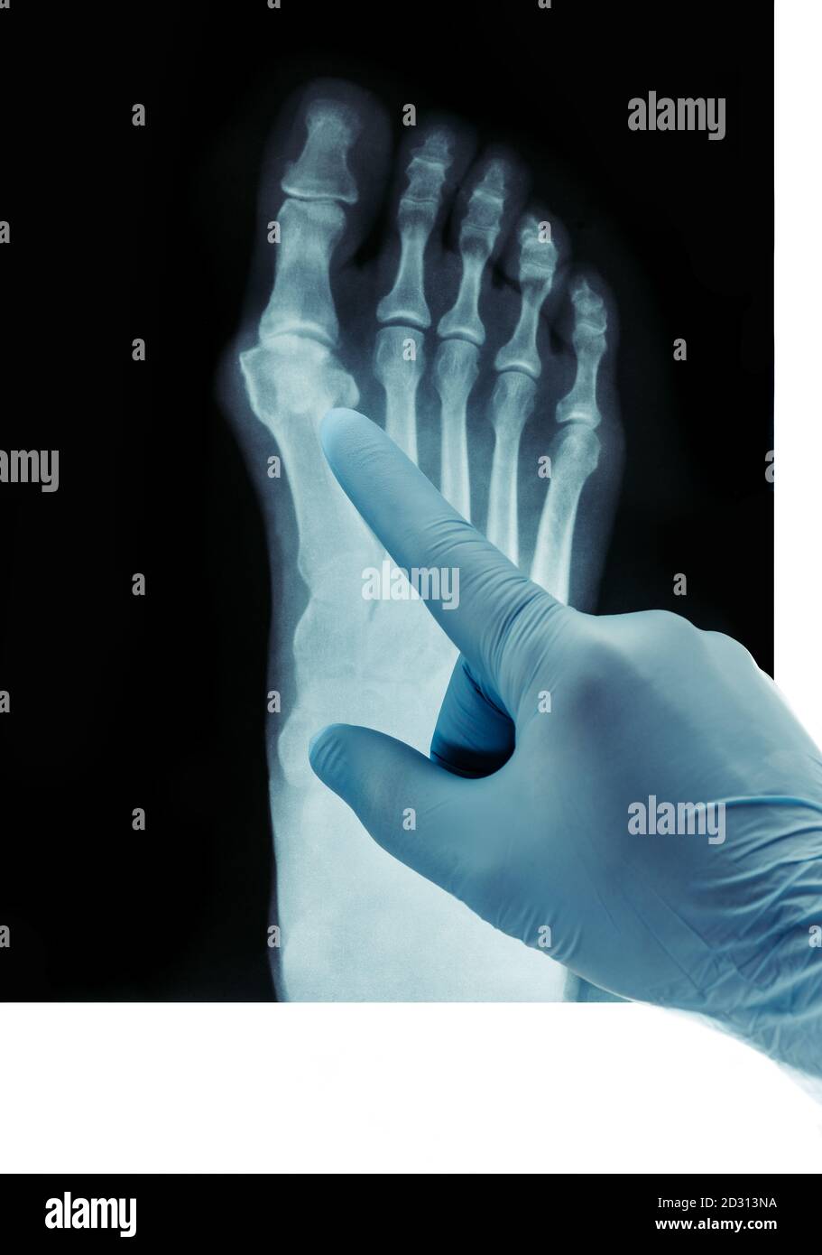 Rayons X des pieds, difformité de valgus de l'orteil ou d'un os sur un doigt maladie orthopédique de 3e degré. Banque D'Images