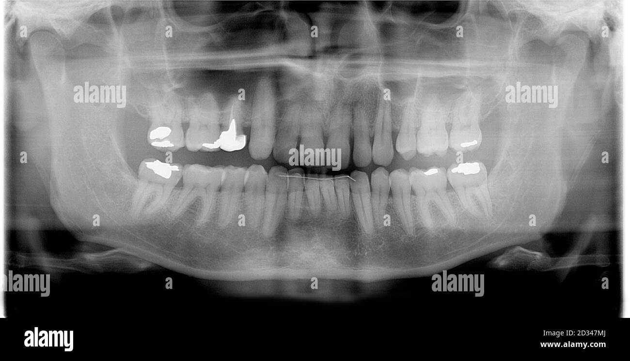 photo rtg (rayons x) des dents de l'homme comme arrière-plan médical Banque D'Images