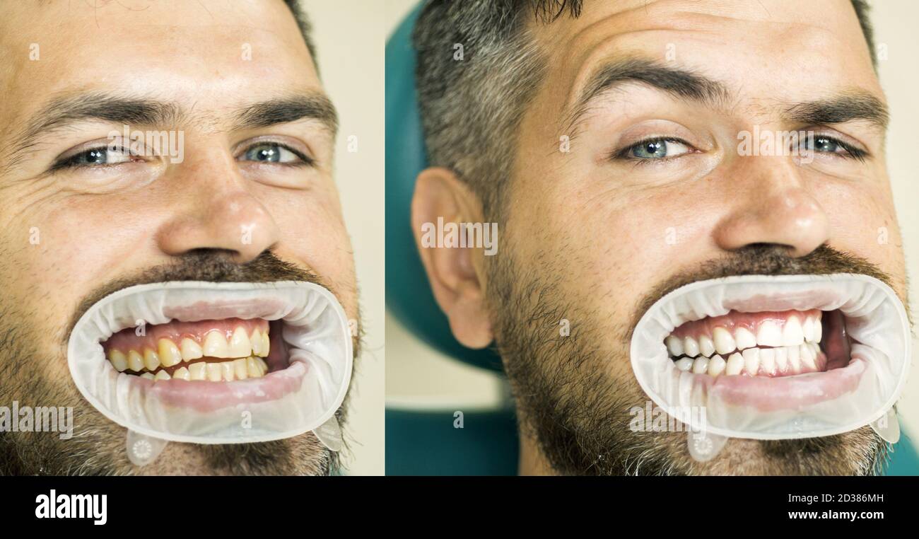 Dents jaune vs blanc, avant ou après le blanchiment. Homme avec un arrière-plan isolé touchant la bouche avec une expression douloureuse à cause de maux de dents ou dentaires Banque D'Images