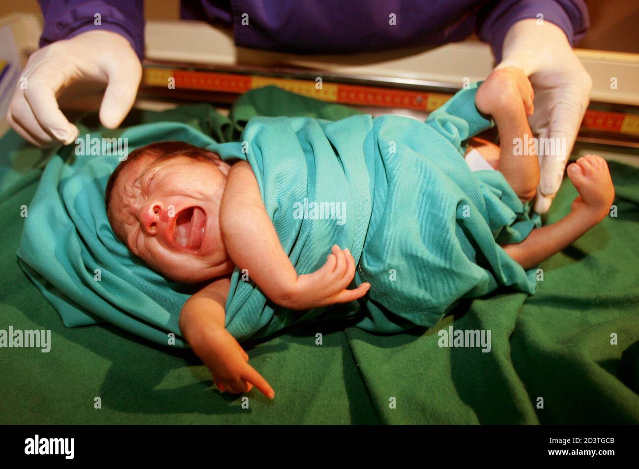 Peruvian One Month Old Baby Moises Chavez Known As The Lobster Baby Because Of A Rare Condition In Which His Arms And Legs Are Wrapped Like Claws Around His Body Is Shown By Dr