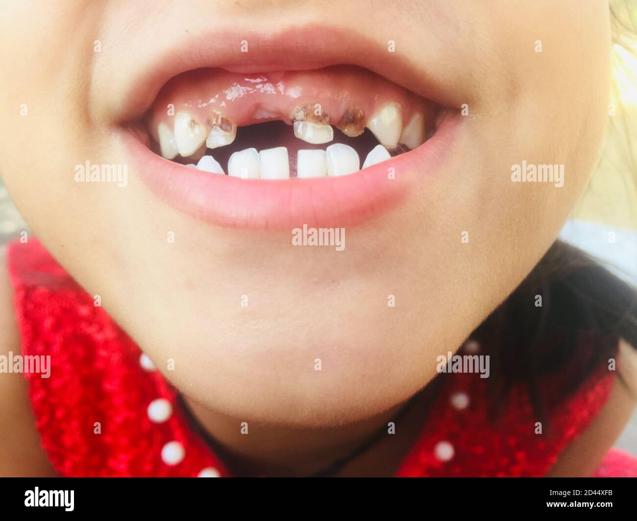Une fille à bouche ouverte montrant ses dents pour vérifier son infection de cavité et de maux de dents.dent décayée, problème dentaire et maladie de dent. Banque D'Images