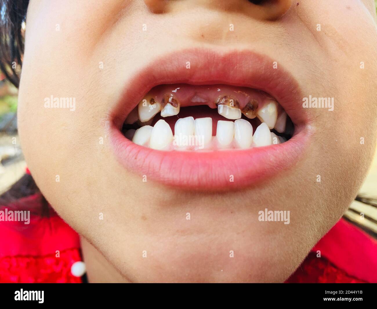 Une fille à bouche ouverte montrant ses dents pour vérifier Son infection de cavité et de maux de dents.dent décadée, problème dentaire et maladie de dent.sélectif foyer Banque D'Images