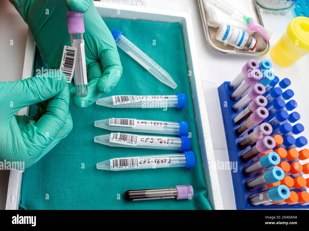 Autocollant scientifique sur le flacon d'échantillon sanguin contenant quatre échantillons de liquide céphalorachidien chez les patients atteints de myélite transversale après injection avec une exp Banque D'Images