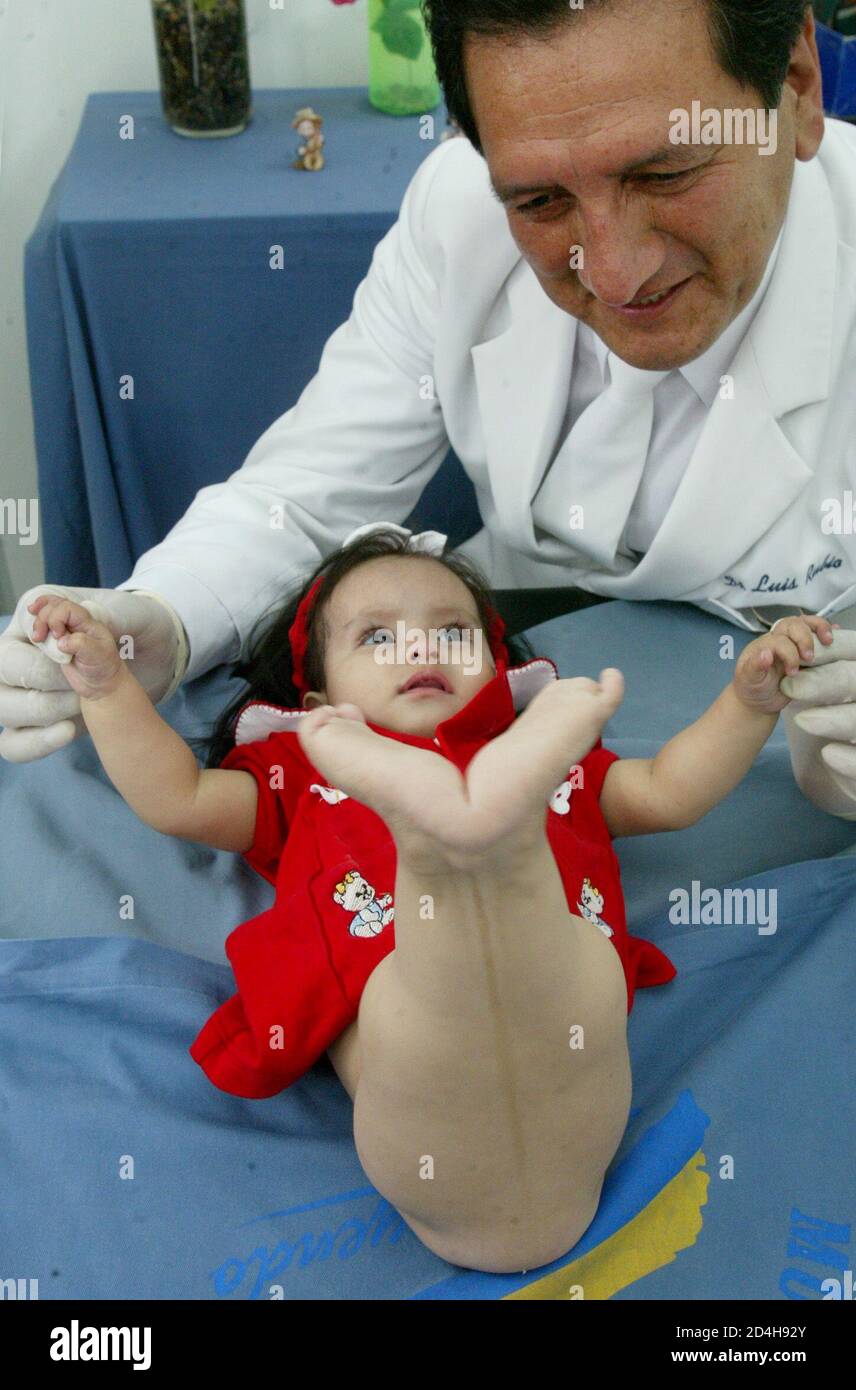 Nine Month Old Milagros Cerron Is Examinated By Doctor Luis Rubio At The Hospital In Lima February 1 05 The Peruvian Baby Dubbed The Little Mermaid Because She Was Born With A Rare Condition