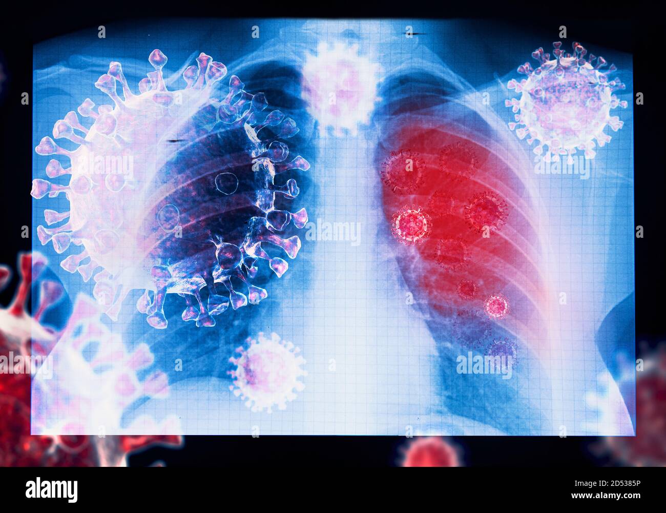 Maladie du coronavirus infection par le virus COVID-19 dans les poumons humains, infection par le nouveau virus corona ou COVID ( nouvelle maladie du coronavirus 2019, COVID-19, nCoV, SAR Banque D'Images