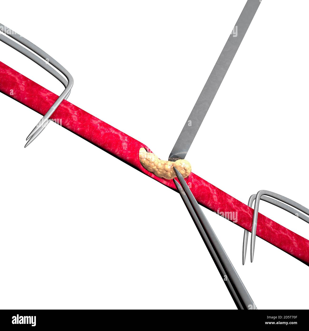 Formation de cholestérol, graisse, artère, veine, coeur. Globules rouges, flux sanguin. Rétrécissement d'une veine pour la formation de graisse. Opération chirurgicale, rendu 3d Banque D'Images