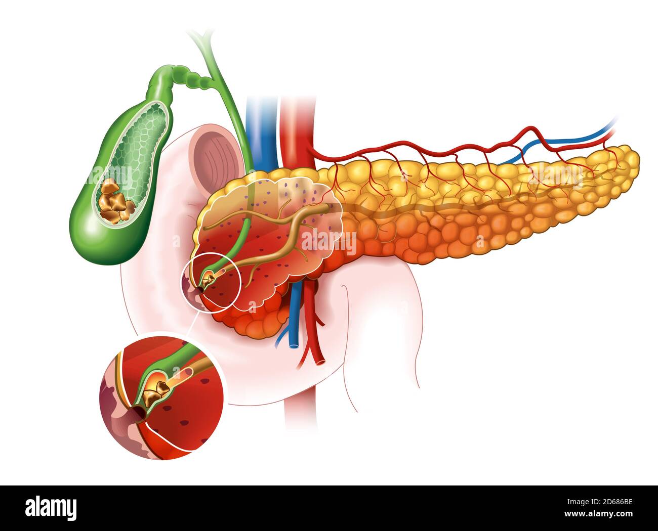 Illustration montrant une inflammation du pancréas, des calculs biliaires bloquant le canal biliaire et le canal pancréatique Banque D'Images