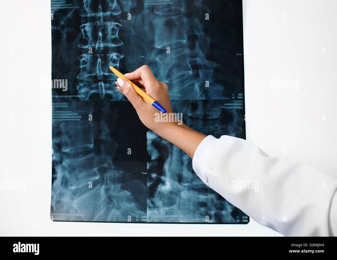 negatoscope pour examiner une radiographie de la colonne cervicale d'un patient. Traitement des maladies de la colonne vertébrale, ostéochondrose et hernie cervicale. Gros plan Banque D'Images