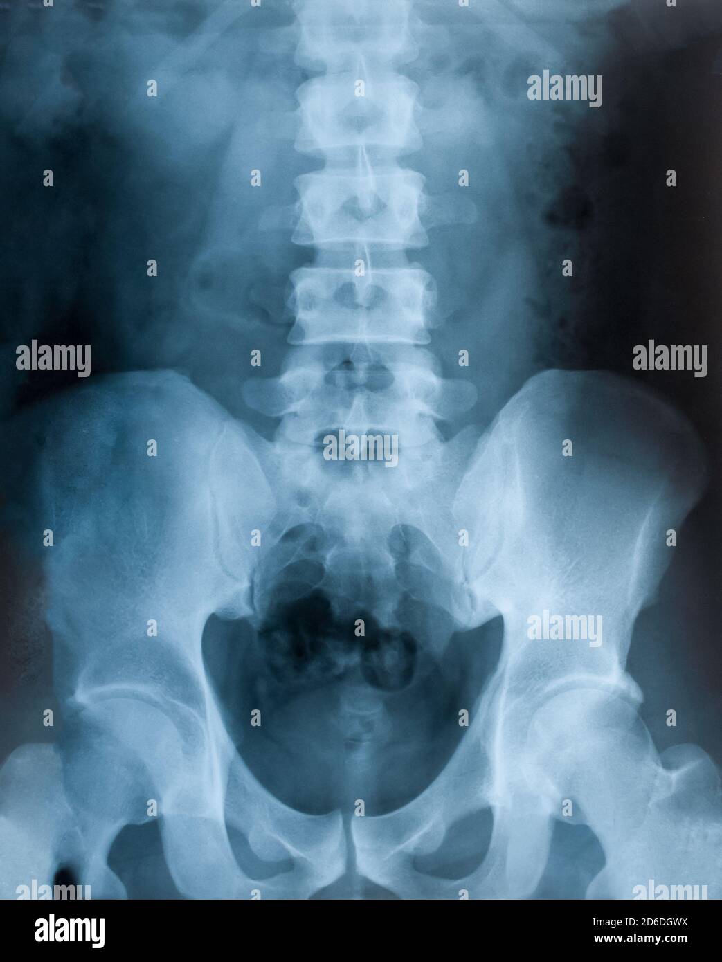 Film radiographique du bassin, examen de santé Banque D'Images