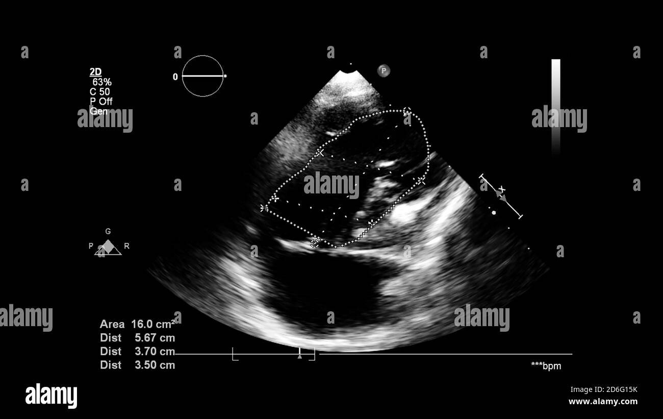 Image du cœur en mode échelle de gris pendant l'échographie transœsophagienne. Banque D'Images