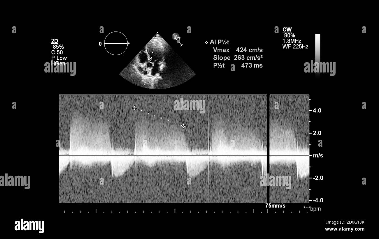 Image du cœur en mode échelle de gris pendant l'échographie transœsophagienne. Banque D'Images