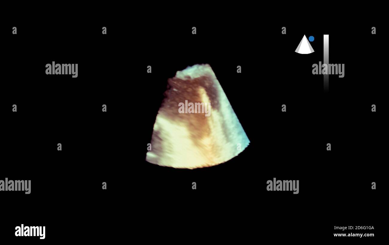 Image 3D du cœur pendant l'échographie transœsophagienne. Banque D'Images