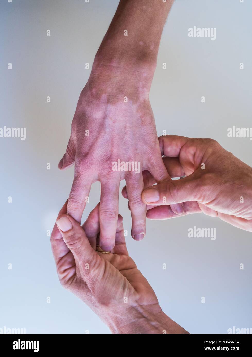 Vue de vitiligo, perte de pigment de peau, dans les mains d'une femme de 35 ans. Banque D'Images