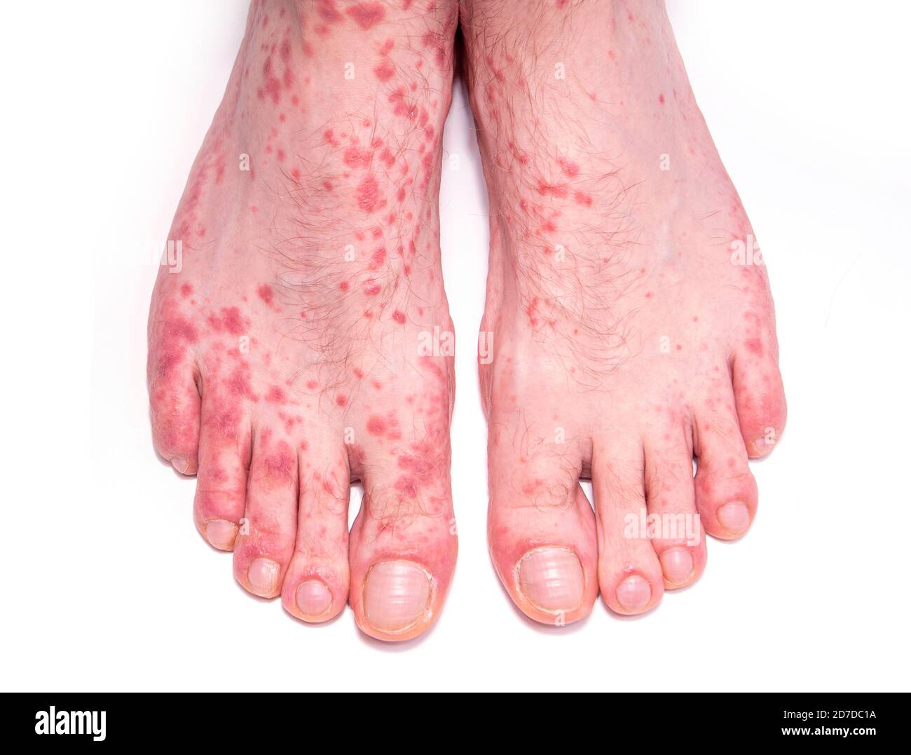 Troubles de la peau comme l'urticaire. Jambes humaines avec éruption isolée sur blanc. Banque D'Images