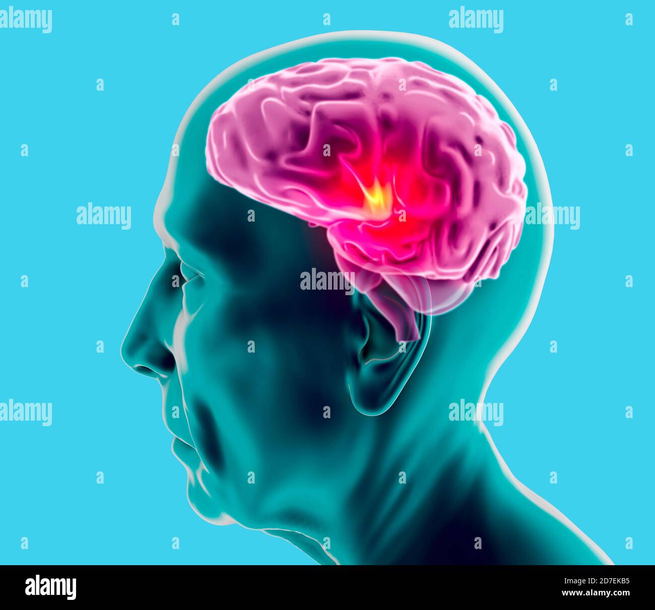 Vue latérale du cerveau d'un homme âgé. Neurones et synapses. Parkinson ...