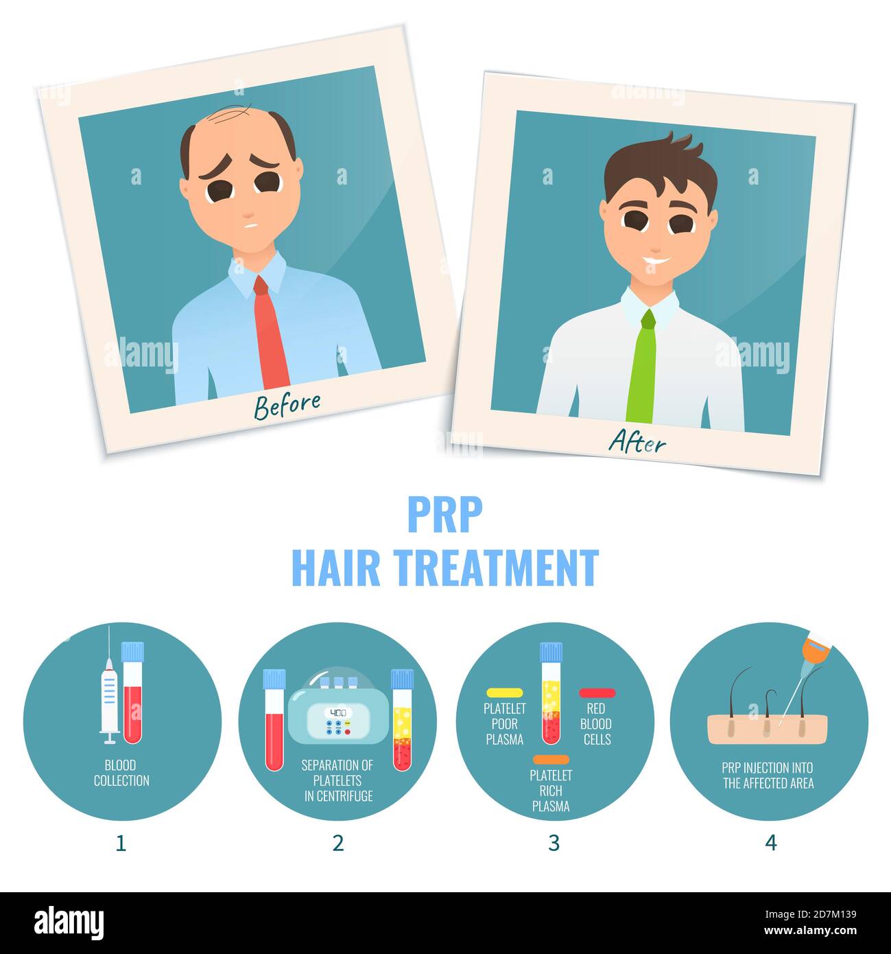 Homme avant et après le traitement PRP (plasma riche en plaquettes) pour la perte de cheveux masculine, illustration. Banque D'Images Homme avant et après le traitement PRP (plasma riche en plaquettes) pour la perte de cheveux masculine, illustration. Banque D'Images