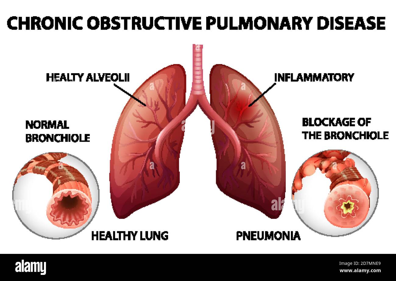 Illustration de la maladie pulmonaire obstructive chronique Illustration de Vecteur