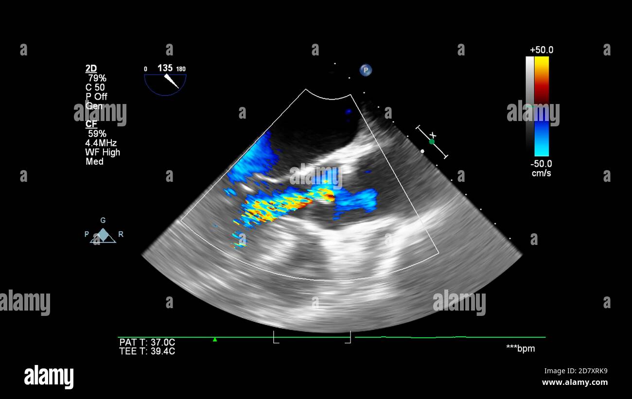 Image du cœur pendant l'échographie transœsophagienne avec mode Doppler. Banque D'Images