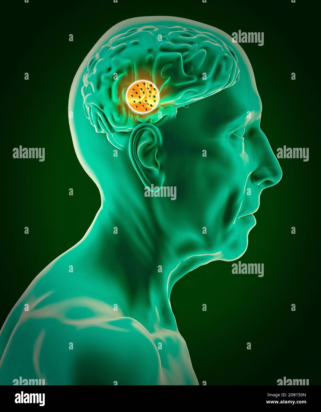 Vue latérale du cerveau d'un homme âgé. Neurones et synapses. Circuit ...