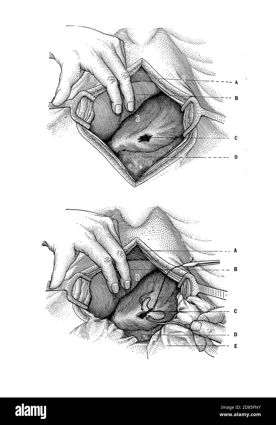 Santé et médecine illustration ancienne: Réparation chirurgicale d'une blessure à l'estomac par balle Banque D'Images