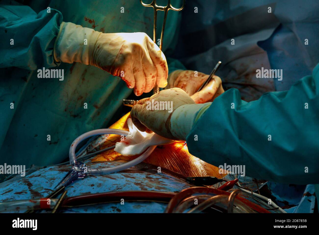 Équipe de chirurgiens en chirurgie à coeur ouvert à l'hôpital en opération chambre Banque D'Images
